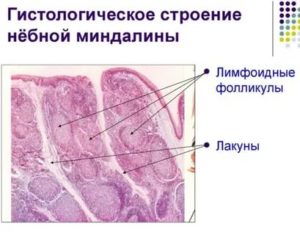 Лимфоидные фолликулы в горле фото