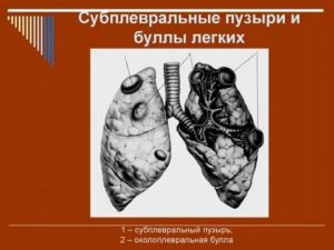 Буллы в легких как лечить