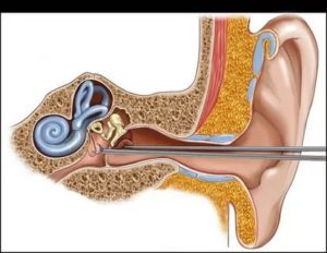 Операция на ухо при отите