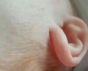 Почему трескается кожа за ушами у ребенка