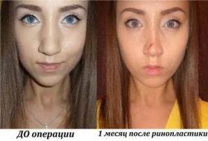 Не дышит нос после ринопластики