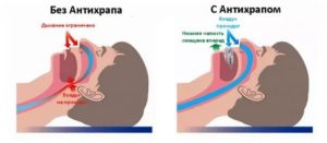 Западает язык во сне причины