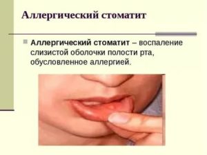 Как лечить воспаление слизистой полости рта