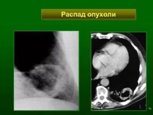 Распад опухоли после химиотерапии