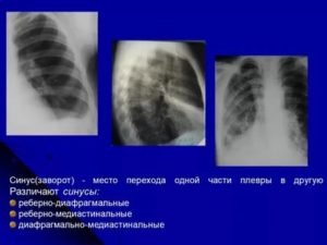 Синусы легких на рентгенограмме