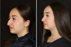 Не дышит нос после ринопластики