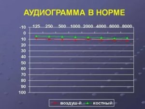 Аудиограмма расшифровка таблица норма