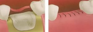 Межзубная перегородка после удаления зуба