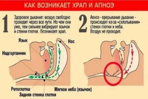 Задержка дыхания во сне у взрослых причины