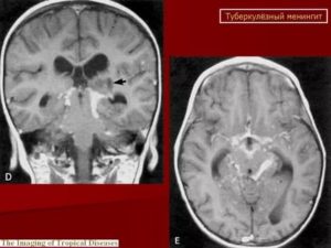 Туберкулез головного мозга симптомы