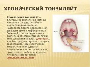 Хронический тонзиллит психосоматика