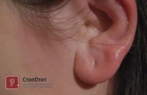 Почему болит мочка уха