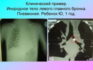 Инородное тело в легких у ребенка симптомы