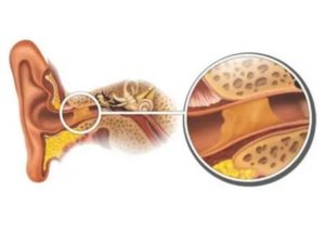 От чего образуется сера в ушах