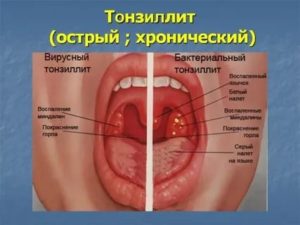Чем лечить слизистую горла