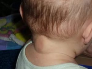 Ребенок чешет уши комаровский