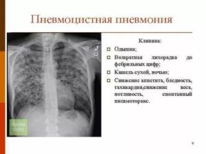 Пневмоцистная пневмония рентгенологическая картина