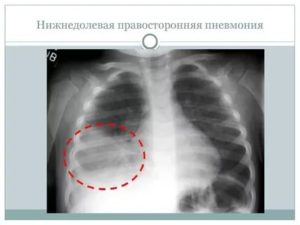 Правосторонняя нижнедолевая пневмония лечение взрослых