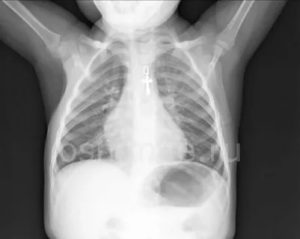 Рентген контроль при пневмонии