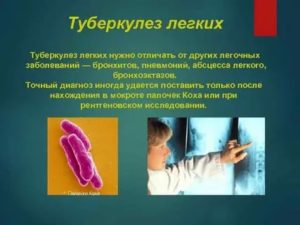 Как отличить туберкулез от бронхита