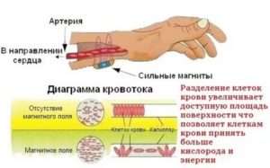 Лечение неодимовым магнитом