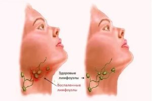Воспаление лимфоузлов на шее при ангине