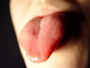 Кровяная шишка на языке