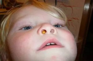 Шишки в носу у ребенка