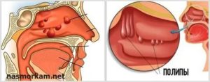Аденоиды и полипы в чем разница