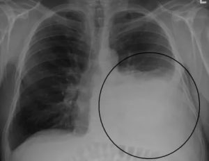 Остаточные явления после пневмонии на рентгене