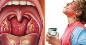 Как закалить горло при хроническом тонзиллите
