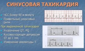 Тахикардия при температуре