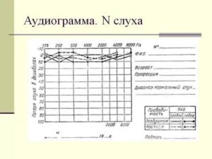 Нормальная аудиограмма фото