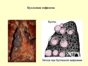 Буллы в легких причины