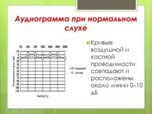 Расшифровка аудиограммы слуха