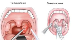 Белые прожилки на миндалинах у ребенка