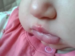 Герпес на губе у ребенка 4 года