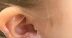 Абсцесс мочки уха