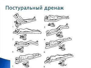 Постуральный дренаж показания и методика проведения