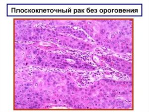 Плоскоклеточный рак с ороговением гортани