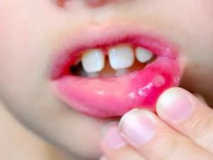 Прикусила губу образовалась язвочка чем лечить
