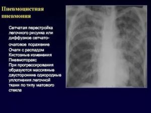 Пневмоцистная пневмония рентгенологическая картина