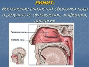 Воспаление слизистой оболочки носа лечение