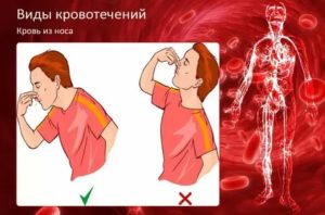 Как остановить кровь из головы
