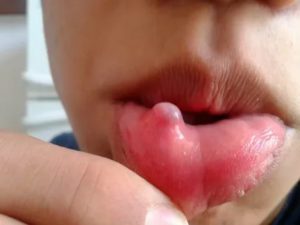 Прикусила губу образовался шарик чем лечить