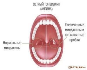 Как отличить тонзиллит от ангины