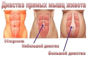 Почему болят мышцы живота без причины