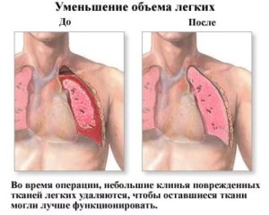 Пробито легкое последствия