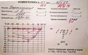 Расшифровка аудиограммы слуха