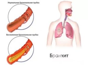 Бронхит и гайморит одновременно